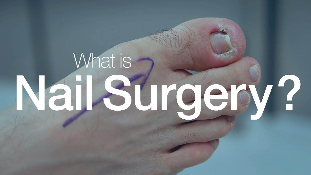Nail Surgery